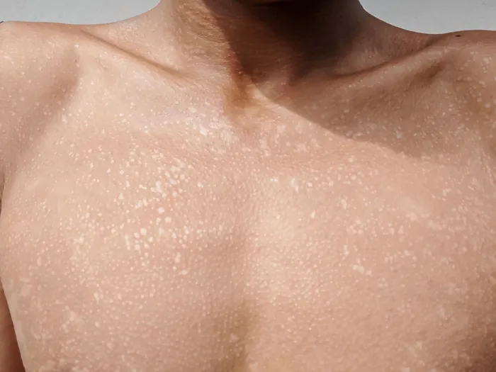 How to Treat Tinea Versicolor Naturally: A Complete Guide tinea versicolor cures